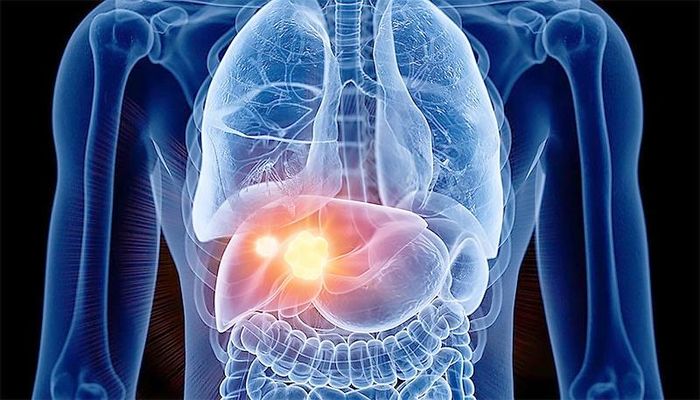 Vì sao người Việt dễ mắc ung thư gan?